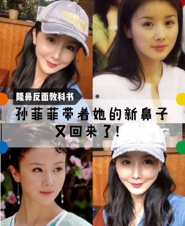孙菲菲整容后无戏可拍_娱乐圈没整过容的明星_娱乐圈整容女明星名单